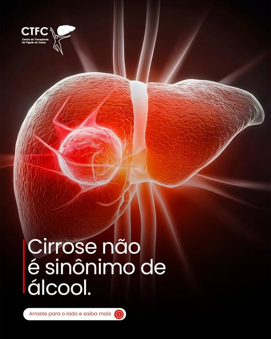 Cirrose não é sinônimo de álcool, CTF Ceará